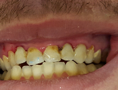 before and after